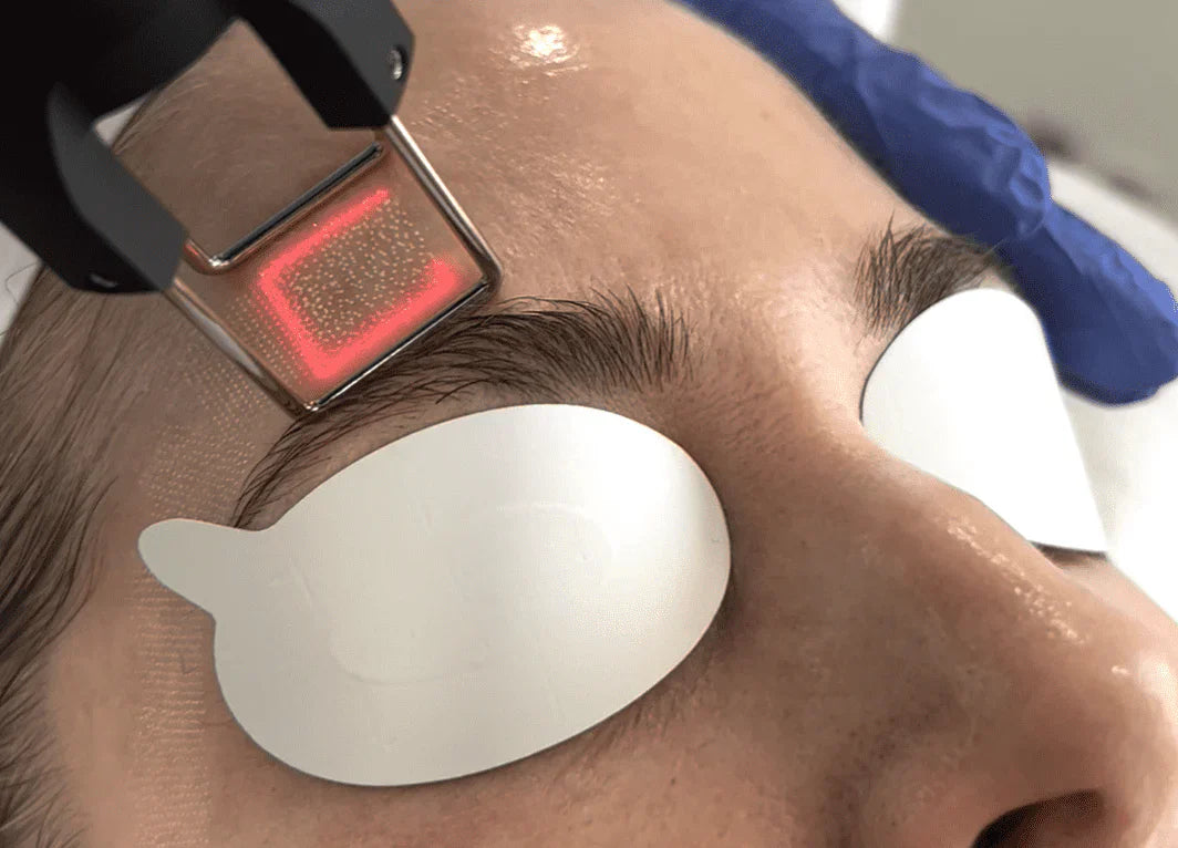 The Benefits of CoolPeel Laser Resurfacing