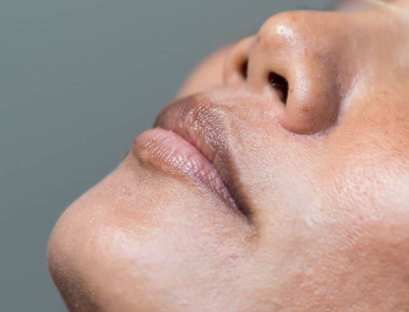 Microneedling: Understanding the Essentials