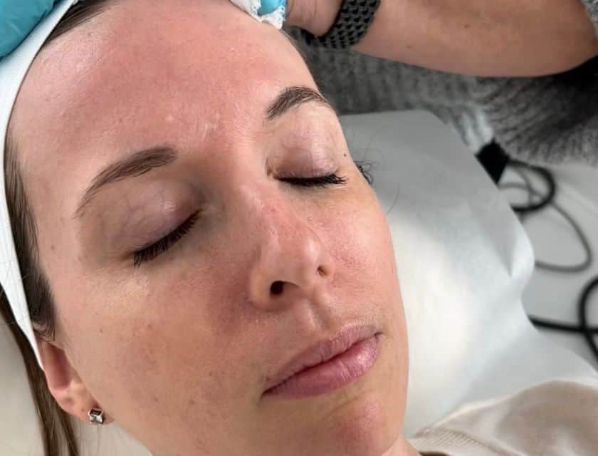 Chemical Peels @CLARA